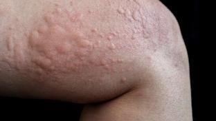 Urticria crnica: MG avana no debate sobre novo protocolo de tratamento