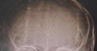 Crian�a � atingida por bala perdida na cabe�a em Contagem