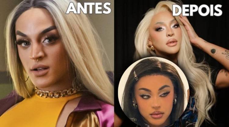 Pabllo Vittar após terceira rinoplastia