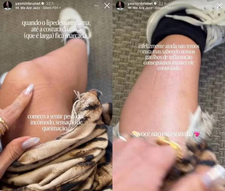 Yasmin Brunet mostra marcas nas pernas e fala sobre efeitos do lipedema
