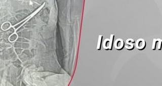 Pin�a � esquecida dentro de idoso durante cirurgia