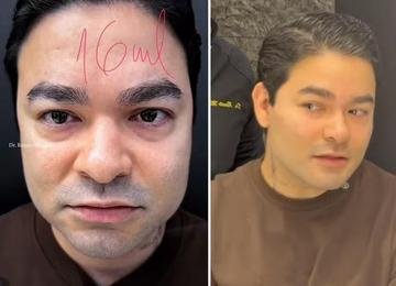 Yudi Tamashiro faz harmonização facial e resultado surpreende