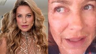 Luana Piovani surge com o rosto machucado e expõe motivo: 'Chapisco'