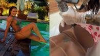 Musa fitness compartilhou reels do procedimento e mostrou o antes e depois do laser