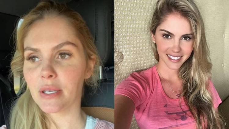 Influenciadora relatou como lidou com a patologia conhecida por causar dores intensas e apar�ncia amedrontadora