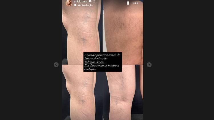 Ana Hickmann iniciou sess�es