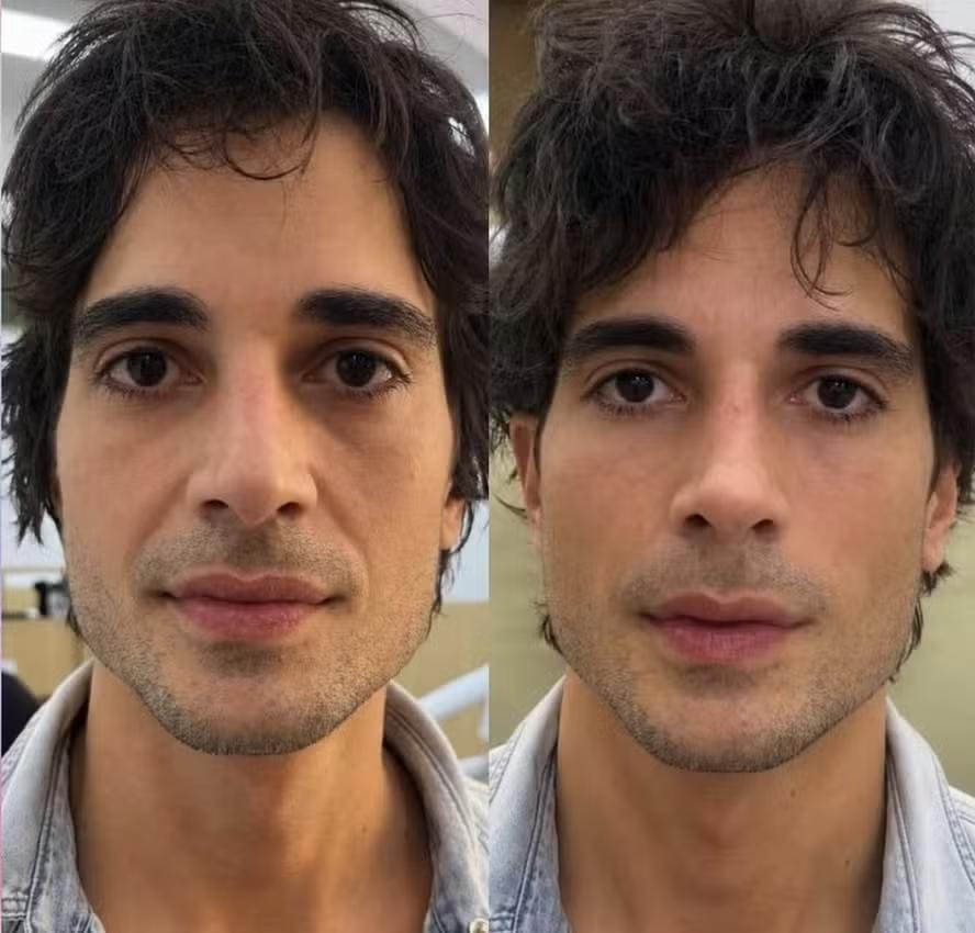 Fiuk faz harmonização facial e muda até o nariz; veja antes e depois