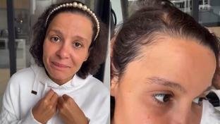 Cantora Maiara desabafa sobre alopecia androgen�tica