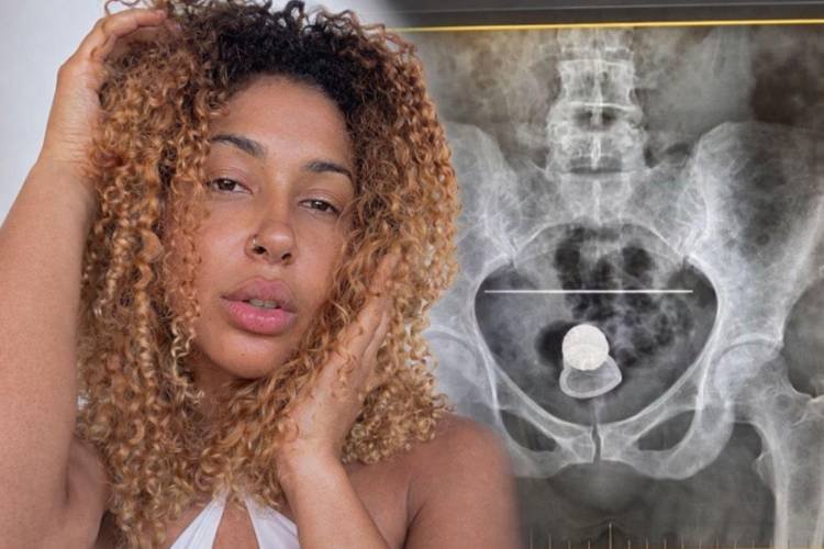 Influencer vai parar no hospital após ficar entalada com plug anal