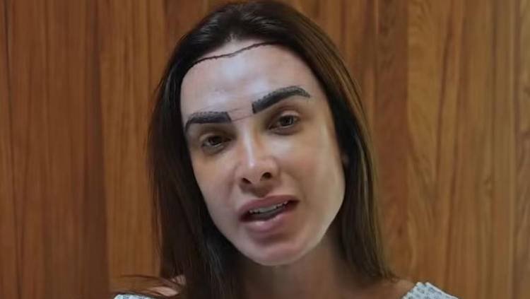 Nicole Bahls mostra procedimento que promete mudar visual sem raspar os fios