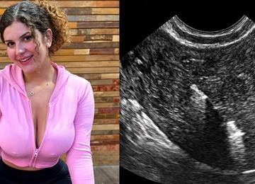 Influenciadora afirma ter perdido DIU após relação sexual e faz descoberta