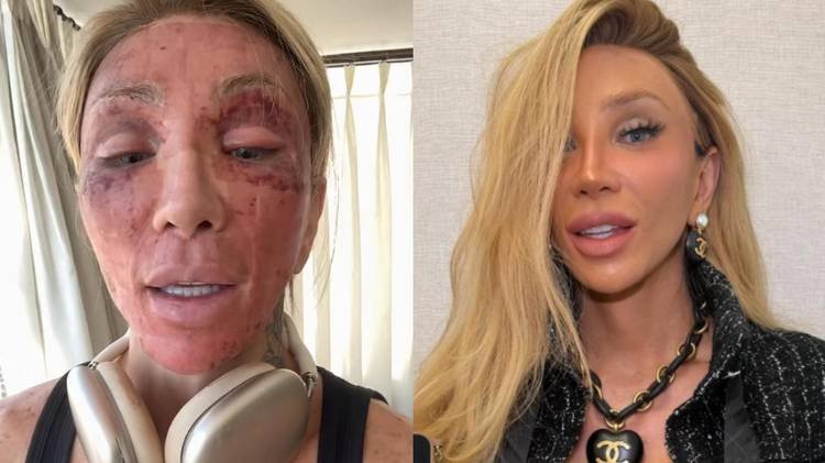 Influenciadora surgiu com o rosto ferido nas redes sociais e justificou o motivo ao público