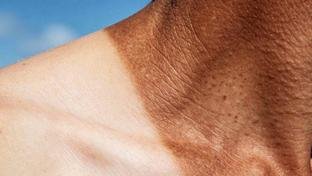 Desinforma��o sobre c�ncer de pele afeta diagn�stico, diz institui��o