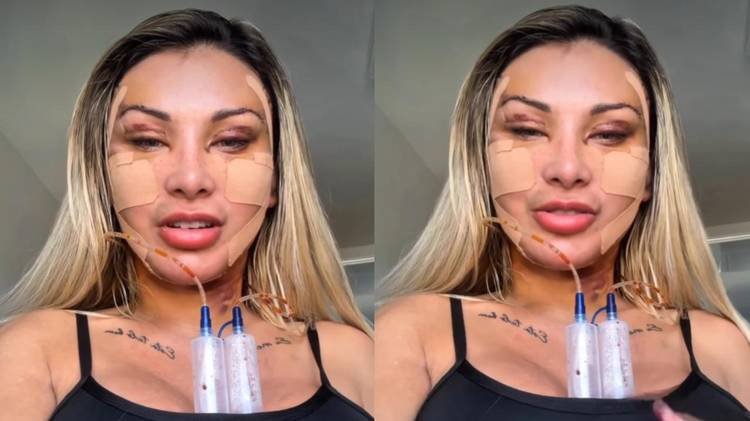 Influenciadora surgiu com o rosto enfaixado nas redes sociais
