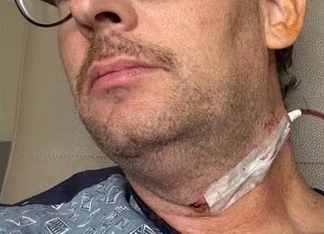 Ator famoso descobre câncer causado por vírus transmitido no sexo e alerta