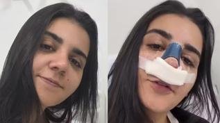 Vdeo: Yasmin Santos mostra antes e depois da rinoplastia e explica deciso