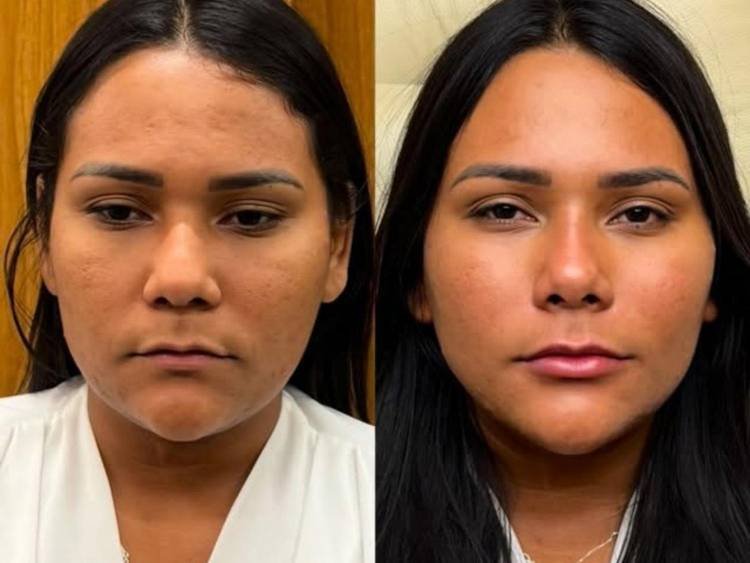 Chaiany Andrade mostra novo visual após harmonização facial e divide antes e depois