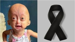 Morre Elis, gêmea que nasceu com síndrome da velhice em Roraima; mãe desabafa: 'Sempre foi'