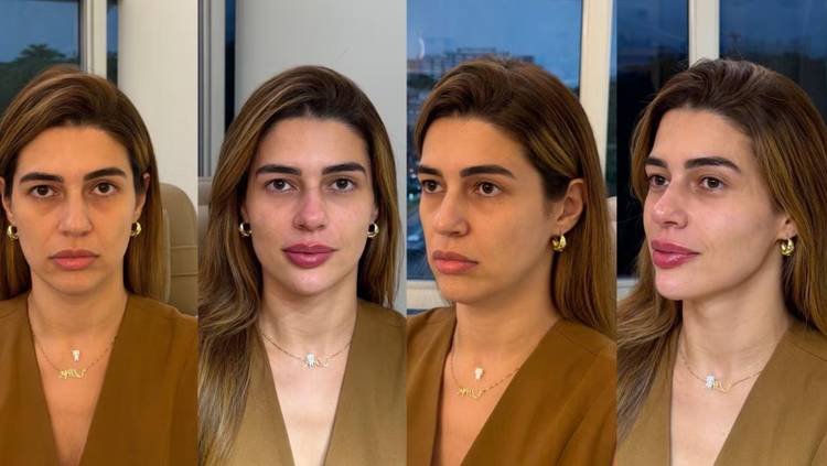 Resultado de harmonização facial