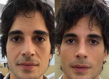 Fiuk faz harmonização facial e muda até o nariz; veja antes e depois