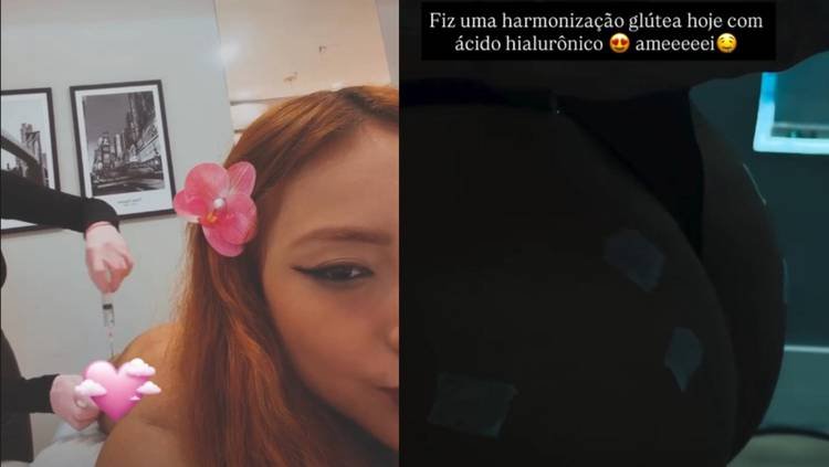 Harmonização no bumbum
