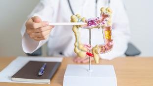 Rastreamento para c�ncer colorretal pode ser implementado no SUS