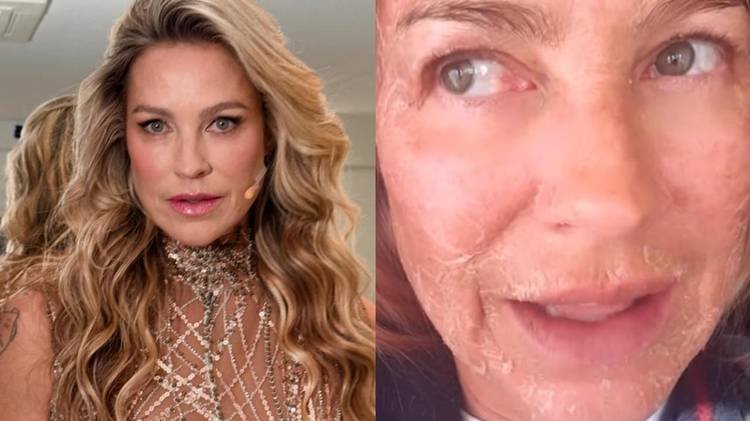 Atriz usou as redes sociais para falar sobre o procedimento facial que realizou recentemente