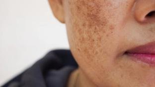 Nem toda mancha no rosto � melasma: saiba como identificar