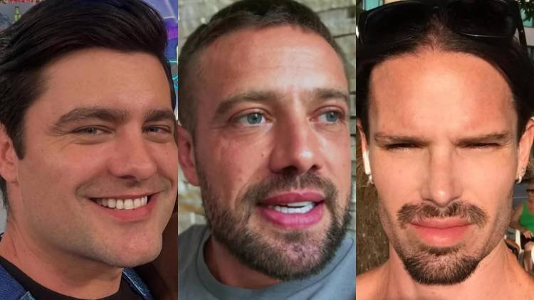 Gal�s da Globo que mudaram o rosto com harmoniza��o facial