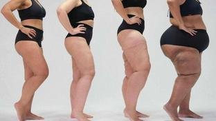 Mitos e verdades sobre o lipedema: condi��o afeta mais mulheres