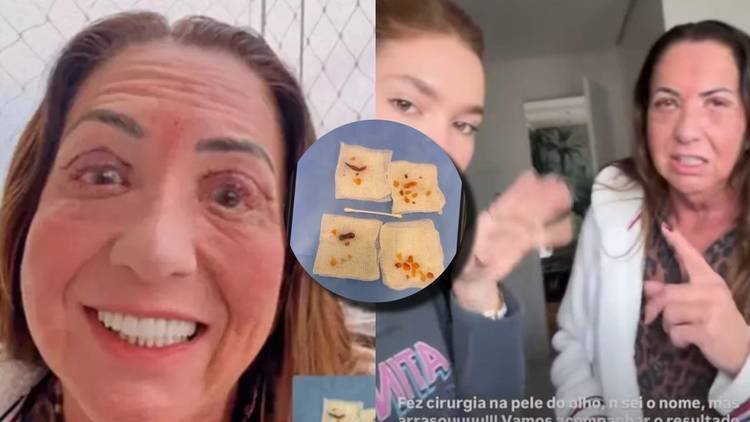 Margareth Serr�o realizou uma blefaroplastia, cirurgia que tira o excesso de gordura e pele na regi�o dos olhos