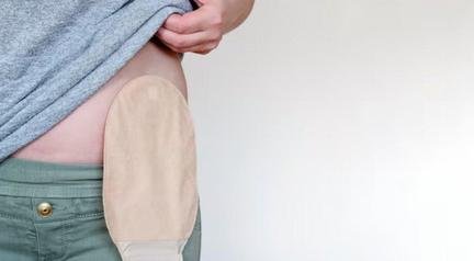 SUS realizou mais de 110 mil cirurgias de ostomia nos ltimos dez anos