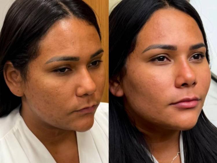 Ex-BBB Chaiany Andrade aposta em harmonização facial discreta e chama atenção nas redes